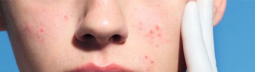 Què és una pell acneica?