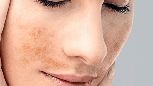 Piel y manchas : cómo poder poner solución