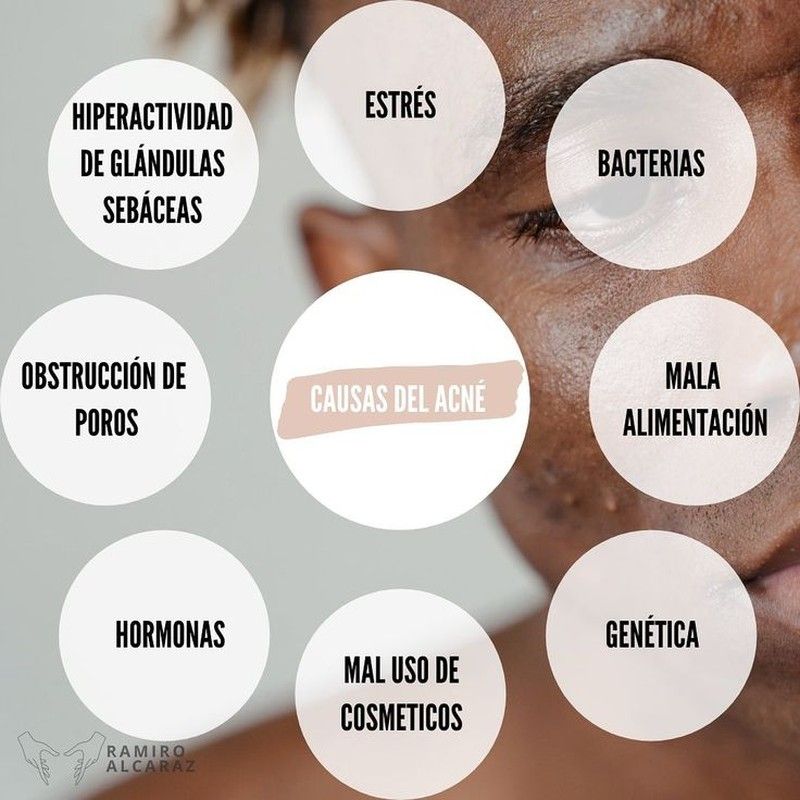 Causas del acné