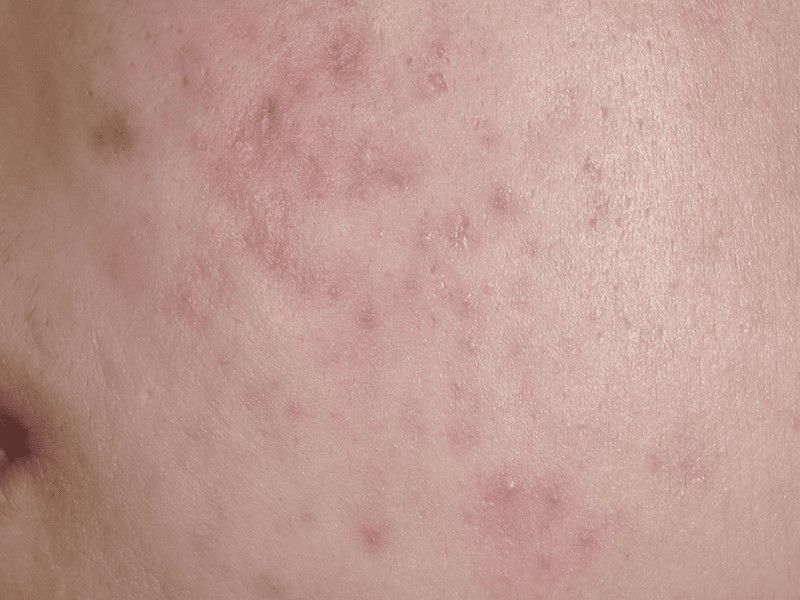 Cuidado con las cicatrices del acné