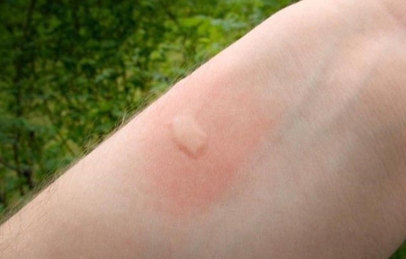 ¿Por qué pican los mosquitos ?