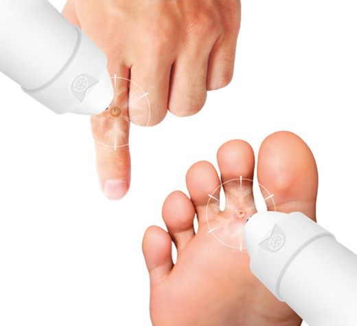 Wortie cool tratamento anti-verrugas para mãos e pés 50 ml